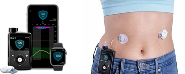 ミニメド 780G (メドトロニック社)