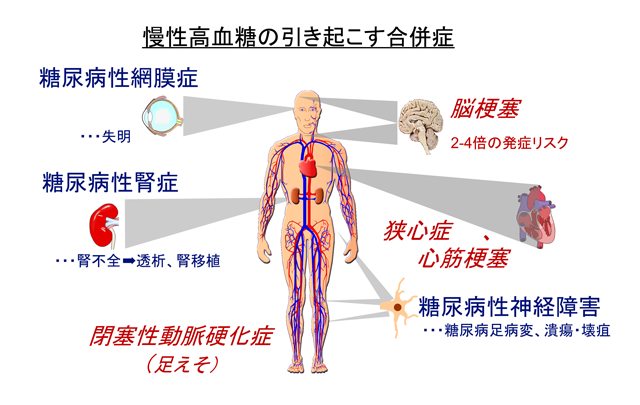 糖尿病の合併症―見えない進行に注意