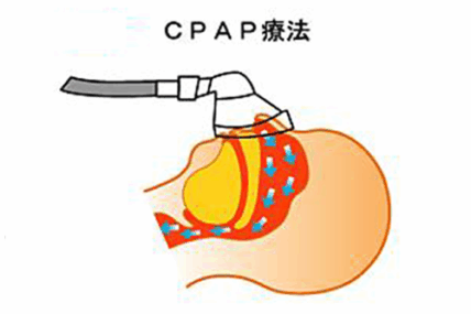 CPAP療法のイラスト