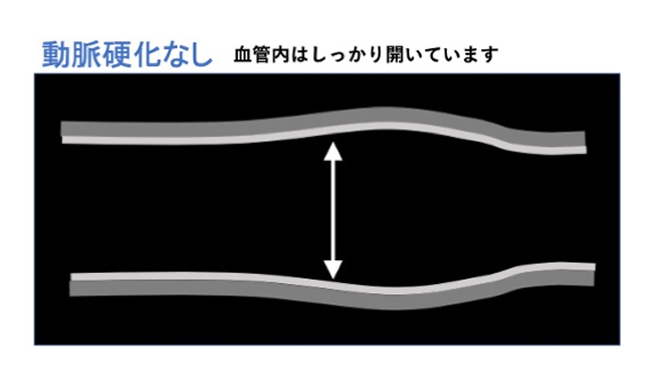 動脈硬化なしの超音波画像のイメージ