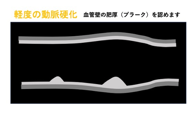 経度の動脈硬化の超音波画像のイメージ