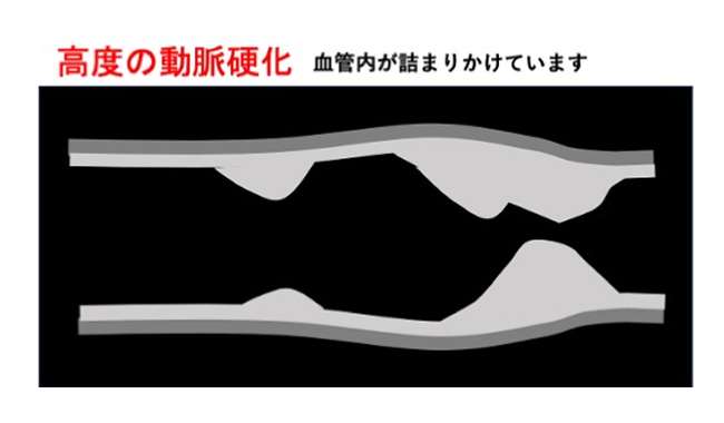 高度の動脈硬化の超音波画像のイメージ