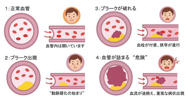 動脈硬化の進み方の図