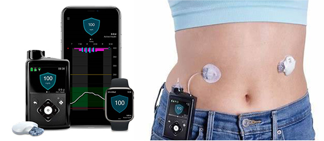 ミニメド780G（メドトロニック社）